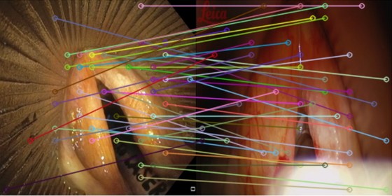 DINOv2 feature matching between laryngoscopic imaging modalities