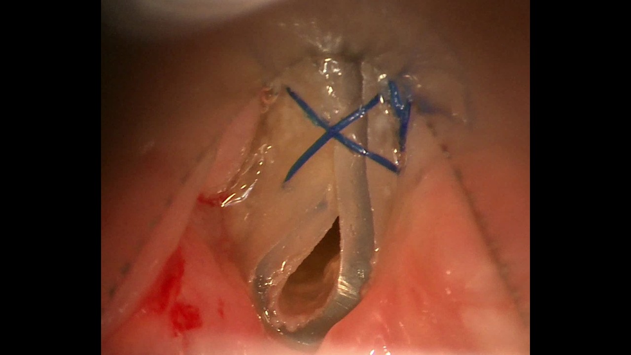 Endoscopic Reconstitution and Transglottic Stent for Radiation-Related Laryngeal Stenosis