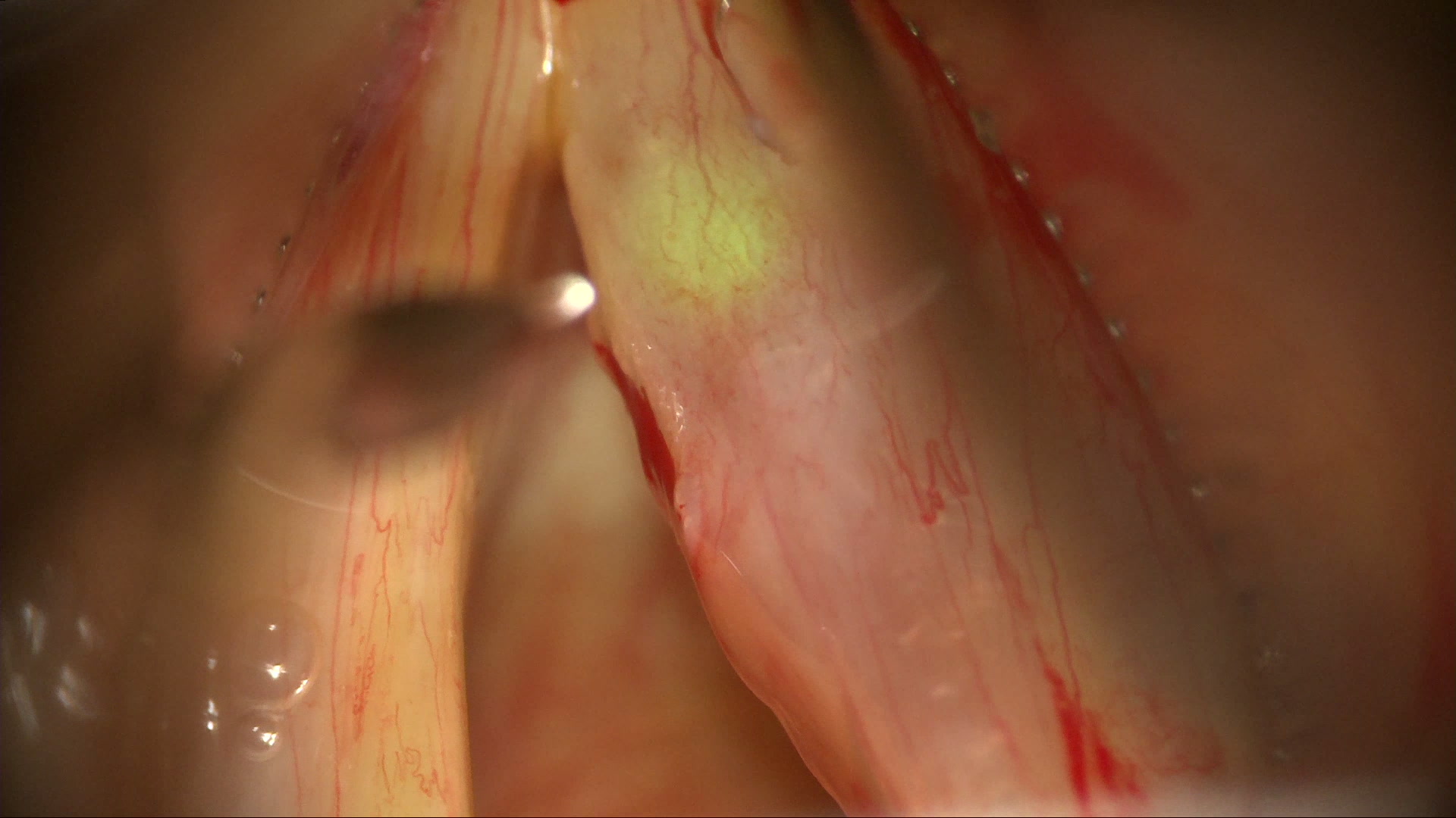 Phonomicrosurgical Resection of Glottic Dysplasia
