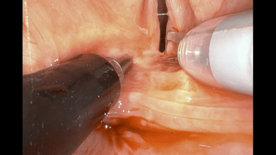 Transoral robotic surgery for laryngeal disease